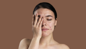 Guide To Acne and Its Treatment by a Dermatologist