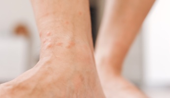 Foot Eczema: What It Is, Types, Risk Factors, & Treatment