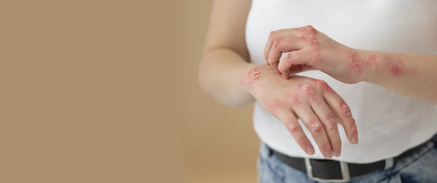Herpes Zoster Vaccine- When Required and Importance?