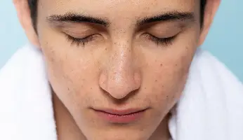 Open Pores: Causes, Prevention, and Treatment Options