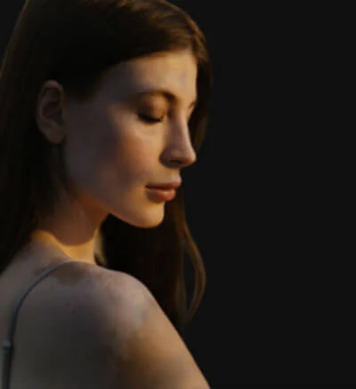 Best Vitiligo Treatment in Bangalore