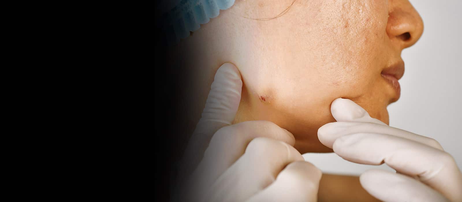 Cyst Removal