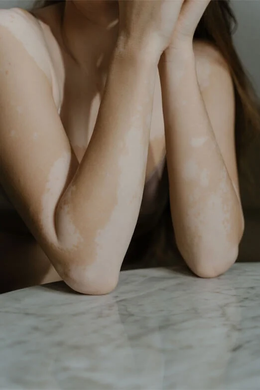 Best Vitiligo Treatment in Bangalore
