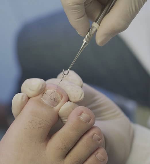 Ingrown Toenail Treatment in Bangalore, JP Nagar Ingrown Toenail