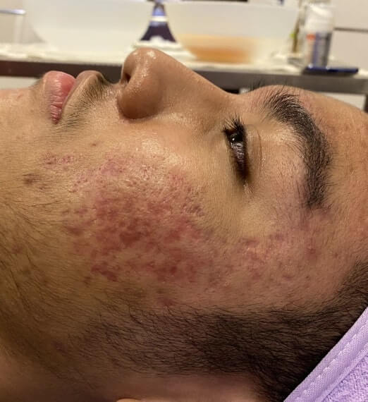 Acne Scar Treatment in Bangalore, JP Nagar Charma Clinic