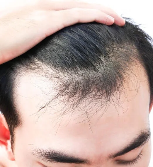 Best Hair Loss Treatment in Bangalore
