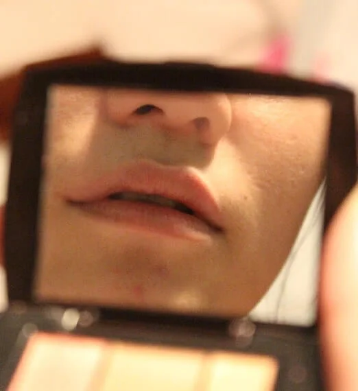 Lip Pigmentation Treatment in Bangalore