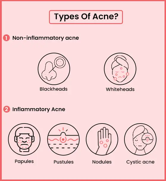 Types Of Acne: Non-inflammatory acne and Inflammatory Acne.