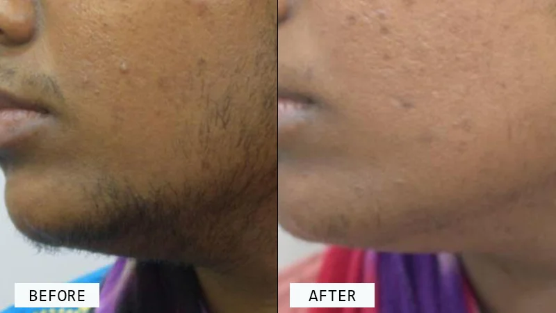 unwanted-body-hair-removal