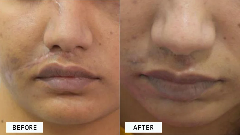 Scar Revision Surgery