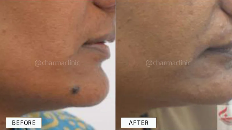 Moles, Warts, and Skin Tag Removal