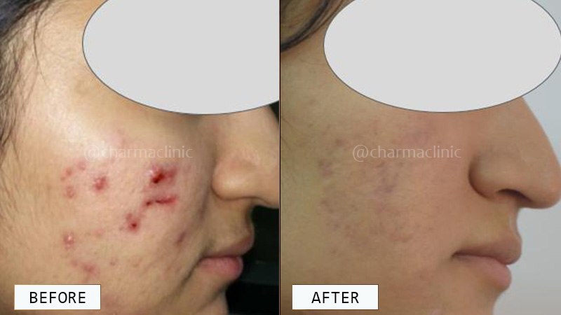 acne-pimple