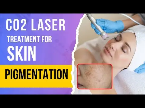CO2 Laser Treatment for Stubborn Pigmentation - Dr. Rajdeep Mysore | Charma Clinic