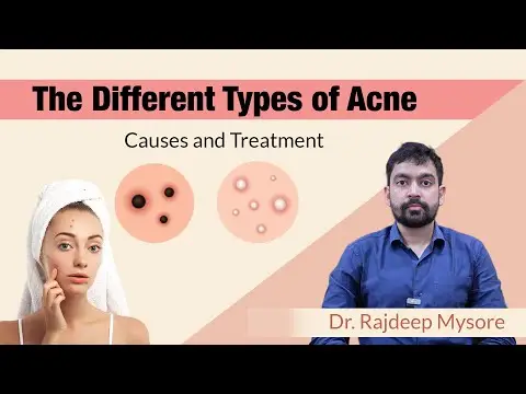 Types of Facial Acne : Causes, Prevention & Treatment - Dr. Rajdeep Mysore | Charma Clinic