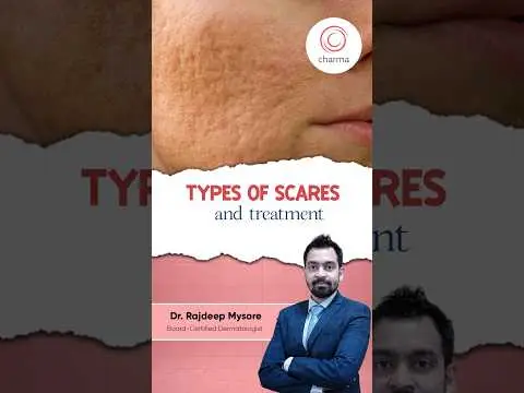 Exploring the Different Types of Acne Scars and treatment - Dr. Rajdeep Mysore | Charma Clinic