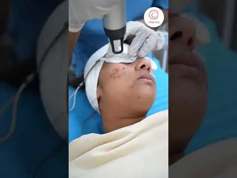 How Laser Toning Treatment Can Transform Your Acne Spots? - Charma Clinic