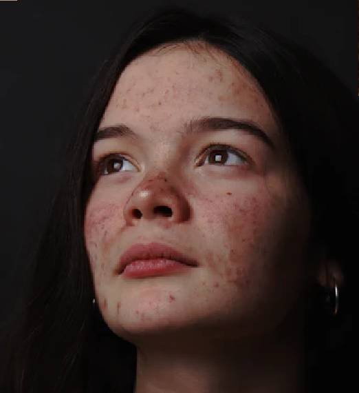 Acne / pimples