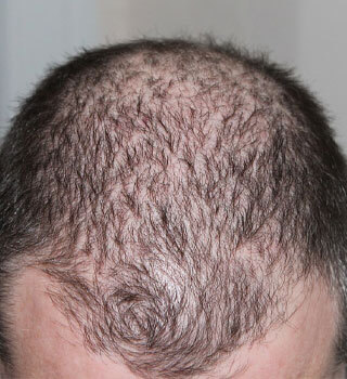 Hair Loss Treatment
