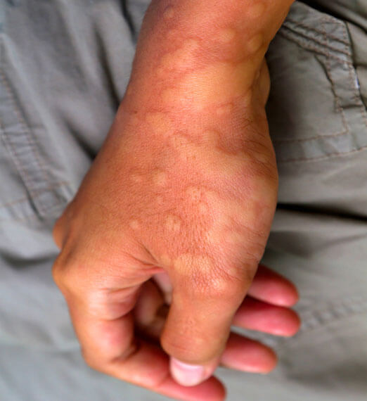 Auto-Inflammatory Conditions