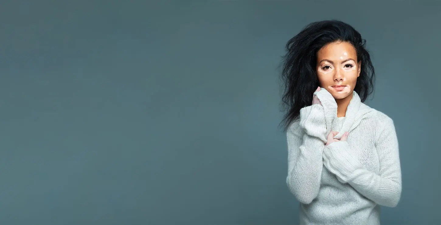 Vitiligo