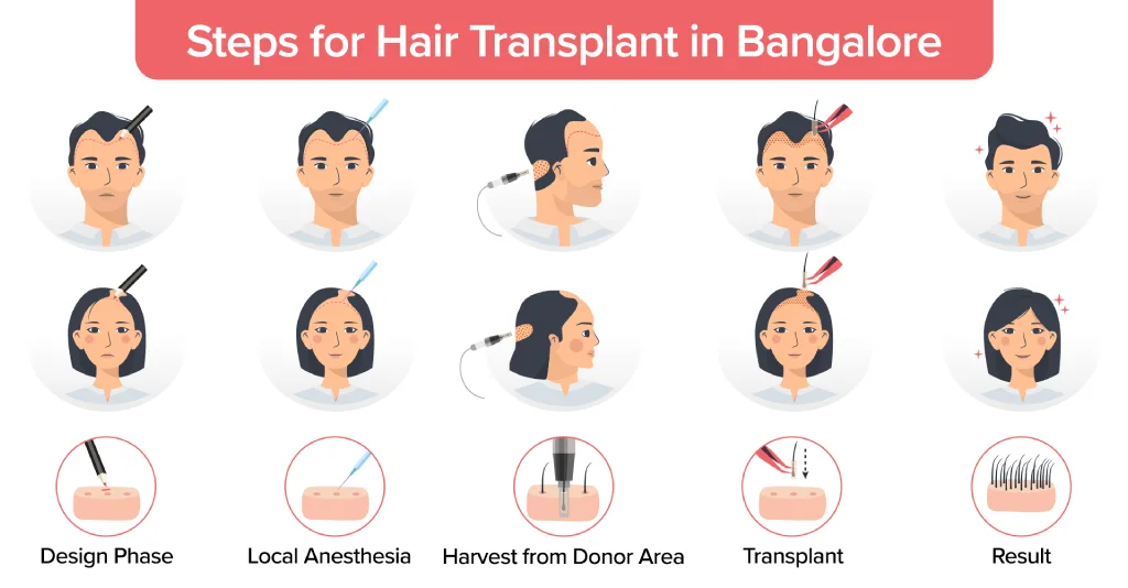 The steps for a hair transplant in Bangalore include the design phase, local anesthesia, harvesting from the donor area, transplant, and results.